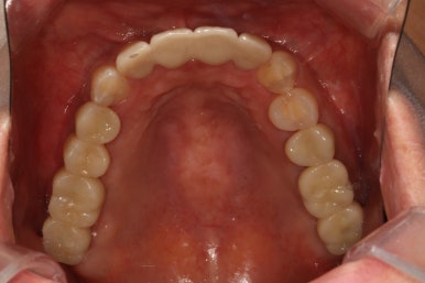 전세계 1위 스트라우만 임플란트를 사용한 어금니 기능회복과 앞니 지르코니아 크라운 증례. 관련 이미지 27