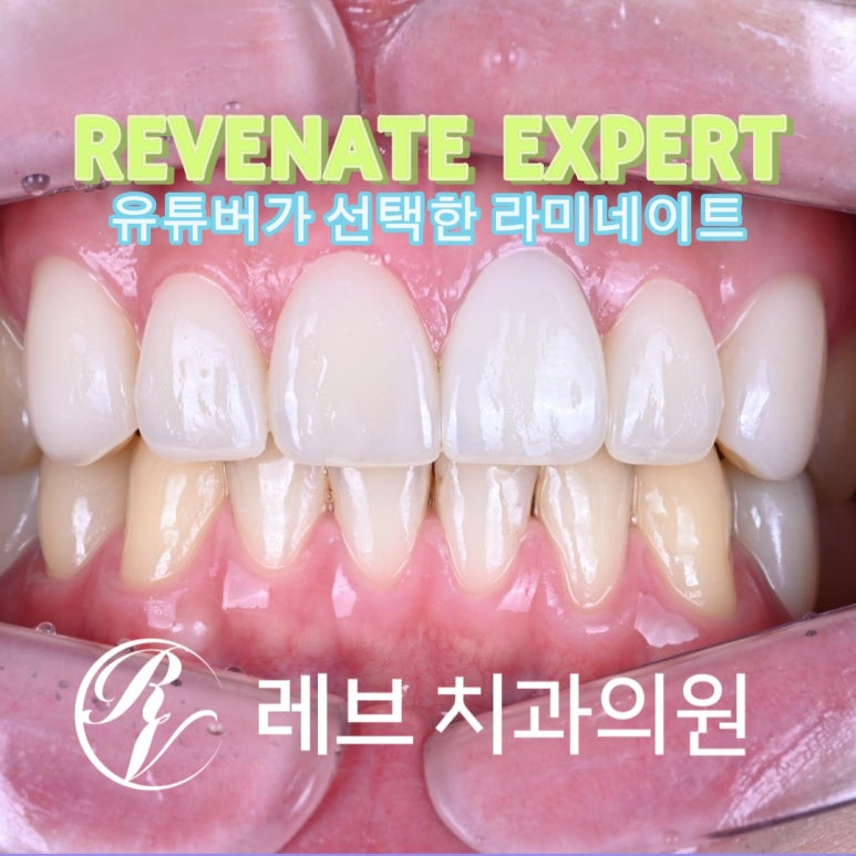 레브네이트 엑스퍼트 ; 유튜버가 선택한 앞니 라미네이트. 앞니 레진 벌어짐을 자연스러우면서 화사하게 바꿔봅시다. 신사역 치과. 치료후기/비용/가격. 관련 이미지 1