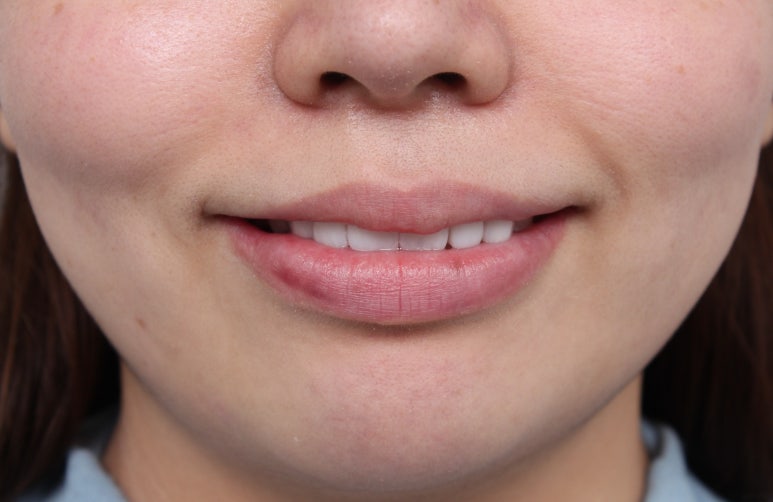 왜소치 라미네이트. 열심히 교정치료 받은 나를 위한 선물. 비용/과정/후기. 관련 이미지 11