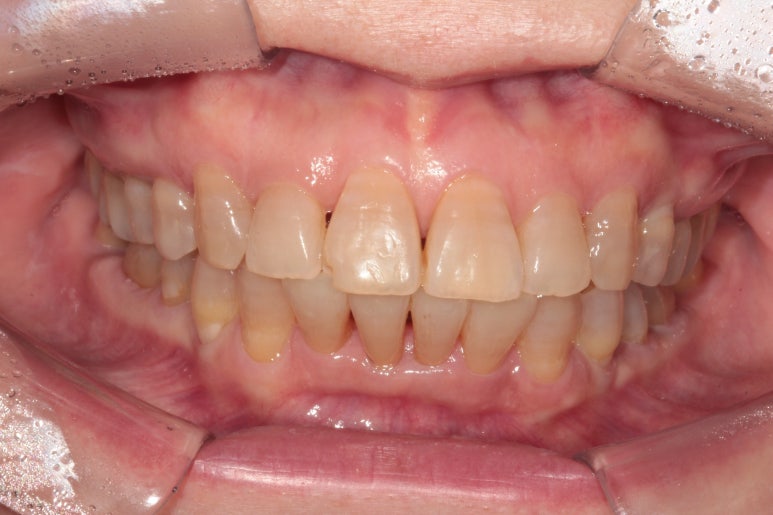 삐뚤어진 앞니를 8개월만에 가지런하게 만드는 50대 성인부분교정. 신사역 교정치과. 치료과정/기간/비용. 관련 이미지 18