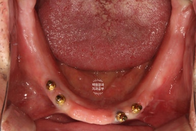 불편한 틀니를 아직도 쓰시나요? 전체 임플란트 치료비용/치료기간/치료과정. 관련 이미지 4
