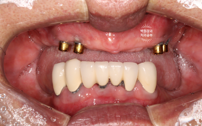 임플란트에서 고름이 나와요. 임플란트 주위염 그리고 재수술을 위한 준비. 치료과정/치료기간/비용/후기. 관련 이미지 4