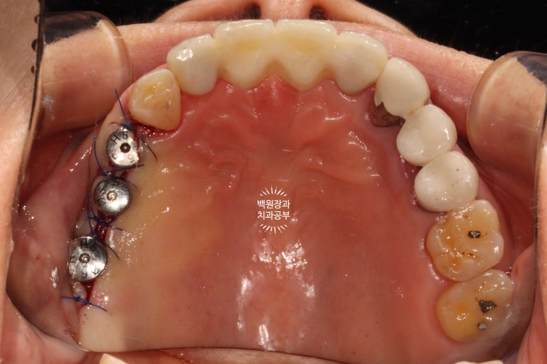 60대 임플란트 주변에서 고름이 나와요. 실패한 임플란트 제거 후 재수술. 덴티움 뼈이식재를 사용한 치조골 이식술. 관련 이미지 15