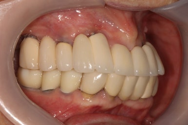 부분틀니를 오래써서 어금니가 아플 때, 아래턱 양쪽 어금니 임플란트 잘하는 강남임플란트치과 관련 이미지 29