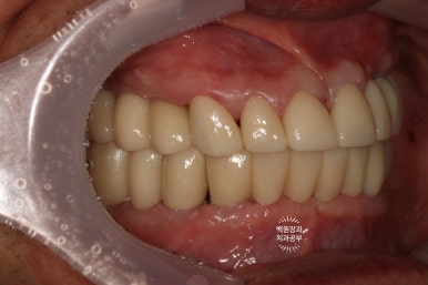 임플란트장인의 마음으로 8개월간 전체임플란트 완성. 치주과 전문의. 관련 이미지 29