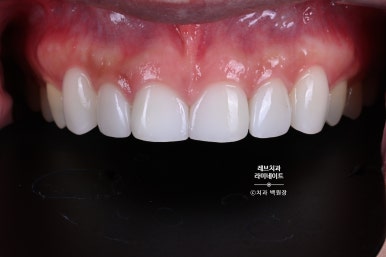 아래앞니 라미네이트도 무삭제로 가능한가요? 레브네이트 베이직 가격/비용/후기/추천. 관련 이미지 2