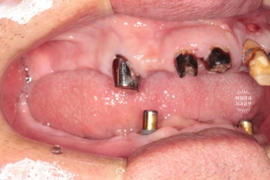 임플란트틀니 - 오버덴쳐. 오스템BA임플란트 이용한 최고의 가성비 치료. 치료과정/치료기간/비용/후기. 관련 이미지 3