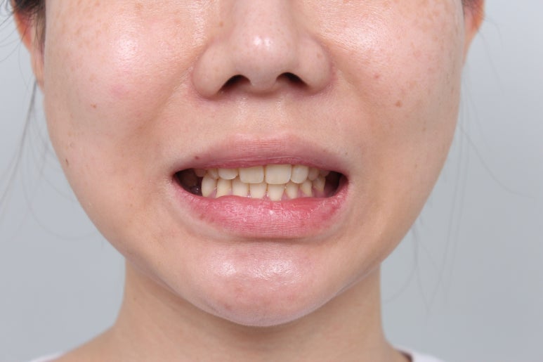 신사역 라미네이트. 결혼식 전 앞니 고민, 얇은 세라믹 레브네이트로 해결! 관련 이미지 9