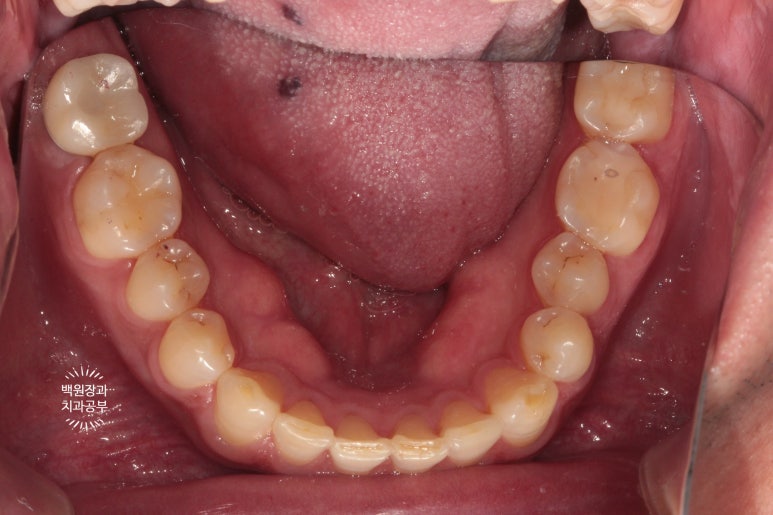아래 어금니가 없어 위 어금니가 내려왔어요. 부분 교정을 곁들인 스트라우만 임플란트 수술. 억울한 신경치료를 피해보자. 치료과정/치료기간/비용/후기. 관련 이미지 15