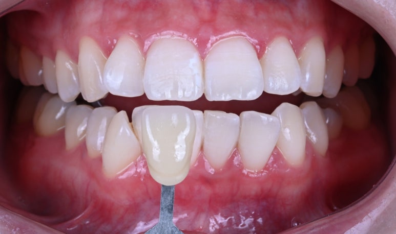 강남 치아미백 성지 레브치과. 가격/비용/부작용/전후사진. 관련 이미지 4