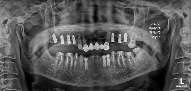 뿌리만 남은 앞니, 어금니가 없어 교합이 무너진 증례. 흡연자의 전체 오스템BA임플란트 재건증례. 치료과정/치료기간/비용/후기. 관련 이미지 16