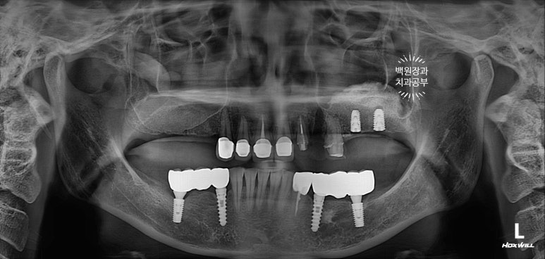 부분틀니 대신 어금니 임플란트를 만들어드립니다. 40대 어금니 상악동 뼈이식 임플란트. 치료기간/비용/과정. 관련 이미지 14