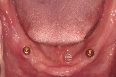 임플란트틀니 - 오버덴쳐. 오스템BA임플란트 이용한 최고의 가성비 치료. 치료과정/치료기간/비용/후기. 관련 이미지 18