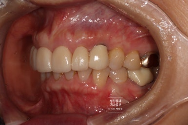 크라운 앞니 충치로 냄새가 나요 - 최소한의 임플란트와 씌우는 치료. 치료과정/기간/비용. 관련 이미지 14