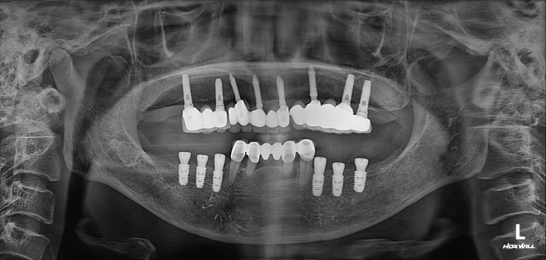 부분틀니를 오래써서 어금니가 아플 때, 아래턱 양쪽 어금니 임플란트 잘하는 강남임플란트치과 관련 이미지 14