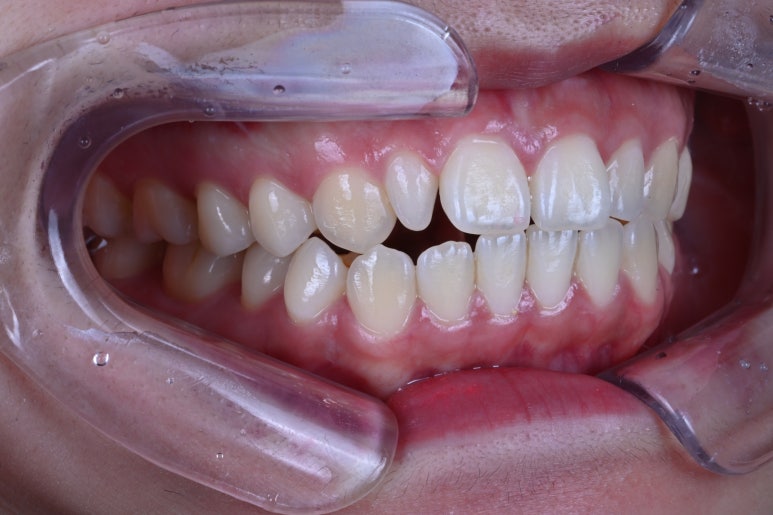 왜소치 라미네이트. 열심히 교정치료 받은 나를 위한 선물. 비용/과정/후기. 관련 이미지 5