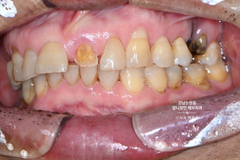 강남논현동치과 60대 치아부러짐 - 신경치료하고 기둥심고 앞니 크라운 잘하는곳! 가격/과정/후기/부작용. 관련 이미지 3