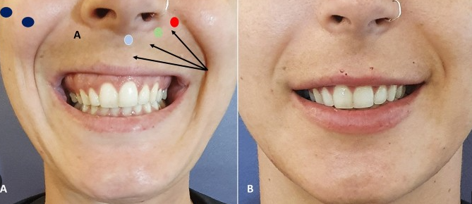 이갈이 보톡스, 신사역 치과 의사가 설명히는 효과, 주기, 통증,가격 총정리 관련 이미지 5