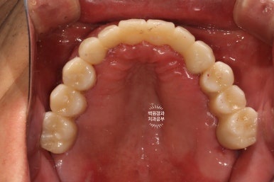 만성치주염으로 인해 아주 좁아진 잇몸뼈에 광범위한 뼈이식 + 전체임플란트. 신사 레브치과. 관련 이미지 56