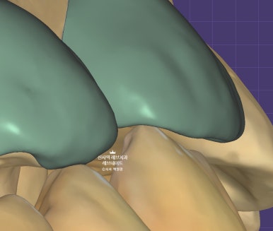 신사역 치과. 아나운서 면접 전 앞니 벌어진 공간을 라미네이트로만 해결할 수 있었던 사연.. 관련 이미지 17