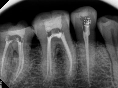 뿌리만 남은 앞니, 어금니가 없어 교합이 무너진 증례. 흡연자의 전체 오스템BA임플란트 재건증례. 치료과정/치료기간/비용/후기. 관련 이미지 12