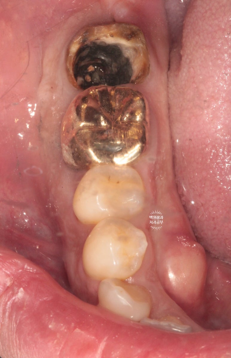 신경치료한 치아 부러짐! 뼈이식 하면서 임플란트 수술하는 과정/기간/비용. 관련 이미지 4