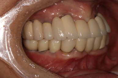 부분틀니를 오래써서 어금니가 아플 때, 아래턱 양쪽 어금니 임플란트 잘하는 강남임플란트치과 관련 이미지 23