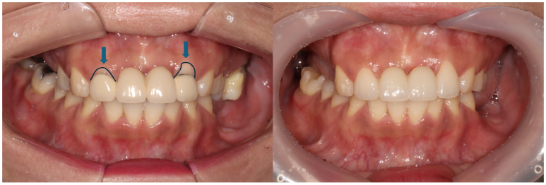 전세계 1위 스트라우만 임플란트를 사용한 어금니 기능회복과 앞니 지르코니아 크라운 증례. 관련 이미지 13