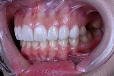 신사역 라미네이트. 결혼식 전 앞니 고민, 얇은 세라믹 레브네이트로 해결! 관련 이미지 19