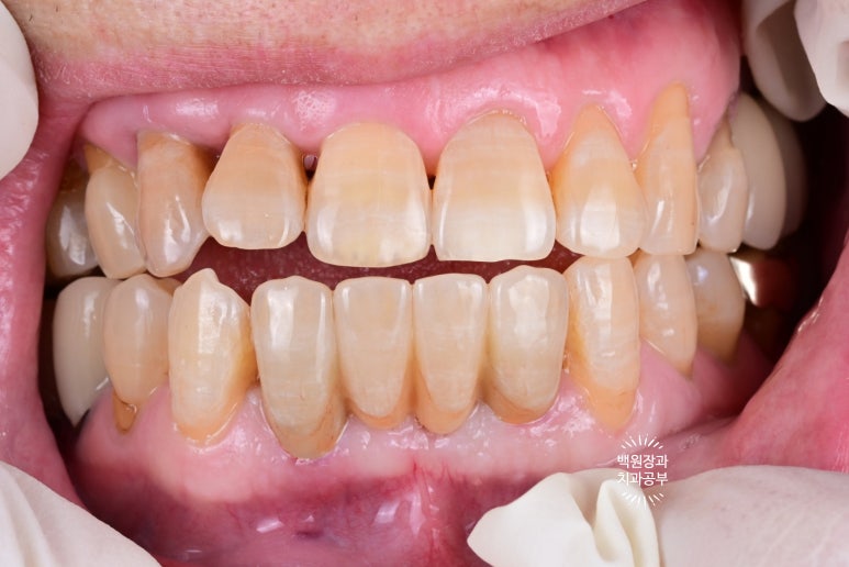 Seoul Sinsa Station [Lev Dental Clinic] For chronic periodontitis, extract the lower front teeth and make the crown look even more real than the real thing with an implant. image 12