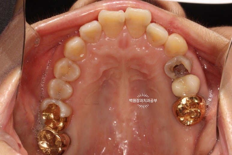 앞니레진치료 할 줄 모르는 치과의사는 없지만, 좋은 레진으로 치료하는 치과의사는 잘 없습니다. 관련 이미지 15