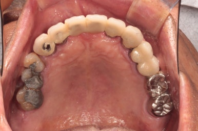 잇몸 염증 고름이 심했던 부위 - 만성치주염 진단하고 임플란트로 깔끔하게 치료! 신사역 치과 관련 이미지 7
