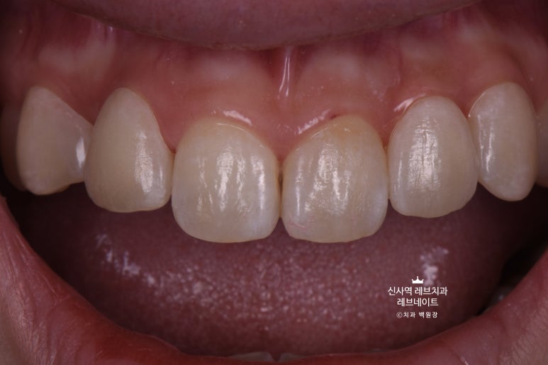 신사역 치과. 아나운서 면접 전 앞니 벌어진 공간을 라미네이트로만 해결할 수 있었던 사연.. 관련 이미지 19