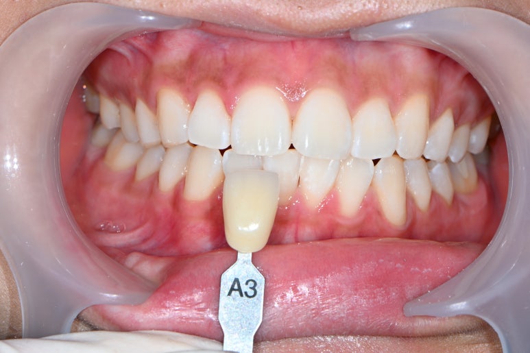 앞니치아미백 비용 들인만큼 잘되는 치과 찾는법. 신사역 치과 미백 성지. 관련 이미지 12