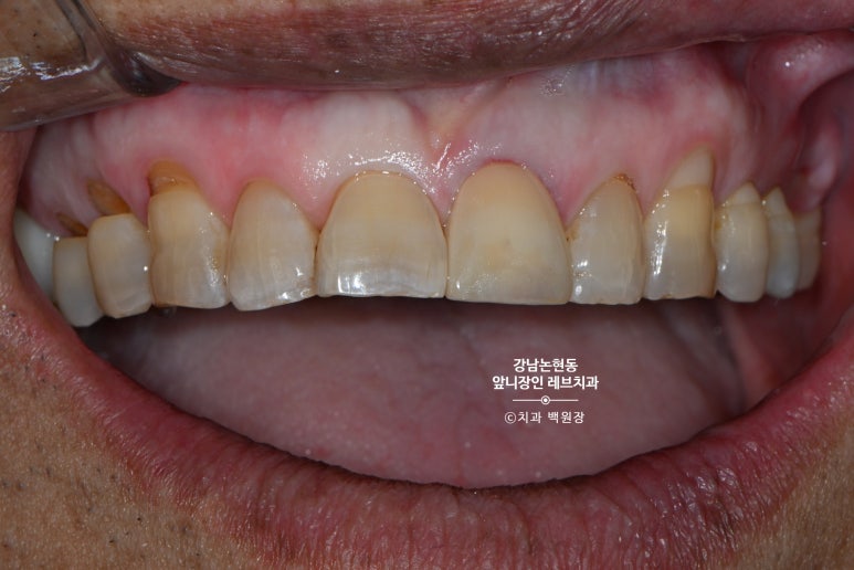 강남논현동치과 60대 치아부러짐 - 신경치료하고 기둥심고 앞니 크라운 잘하는곳! 가격/과정/후기/부작용. 관련 이미지 14