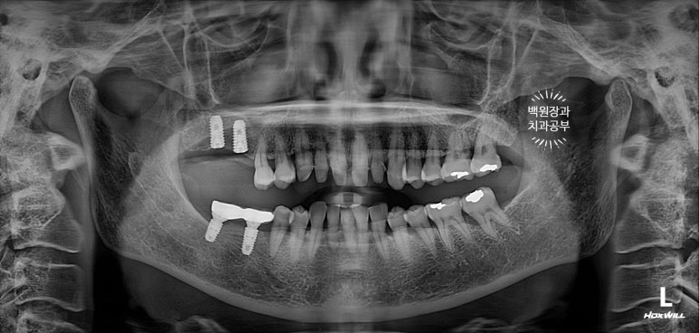 삐뚤빼뚤 앞니 세로 금  - 신경치료 없이 지르코니아 크라운으로. 상악동뼈이식술 임플란트. 관련 이미지 16