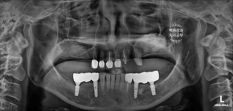 부분틀니 대신 어금니 임플란트를 만들어드립니다. 40대 어금니 상악동 뼈이식 임플란트. 치료기간/비용/과정. 관련 이미지 13