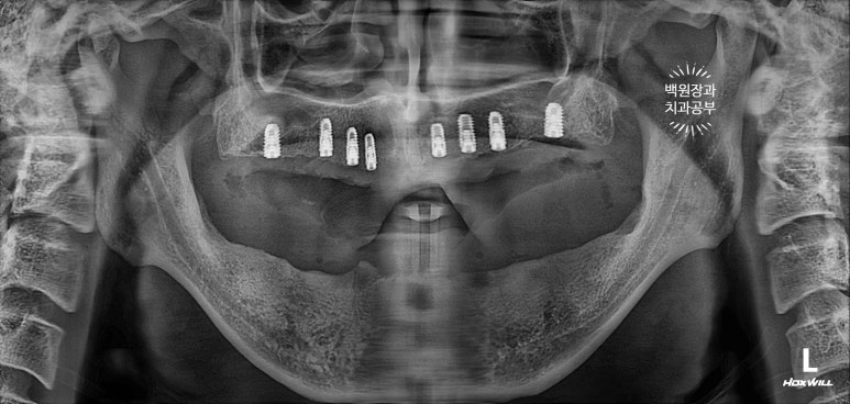 만성치주염으로 인해 아주 좁아진 잇몸뼈에 광범위한 뼈이식 + 전체임플란트. 신사 레브치과. 관련 이미지 31