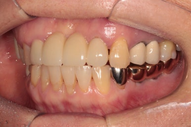 60대 임플란트 주변에서 고름이 나와요. 실패한 임플란트 제거 후 재수술. 덴티움 뼈이식재를 사용한 치조골 이식술. 관련 이미지 13