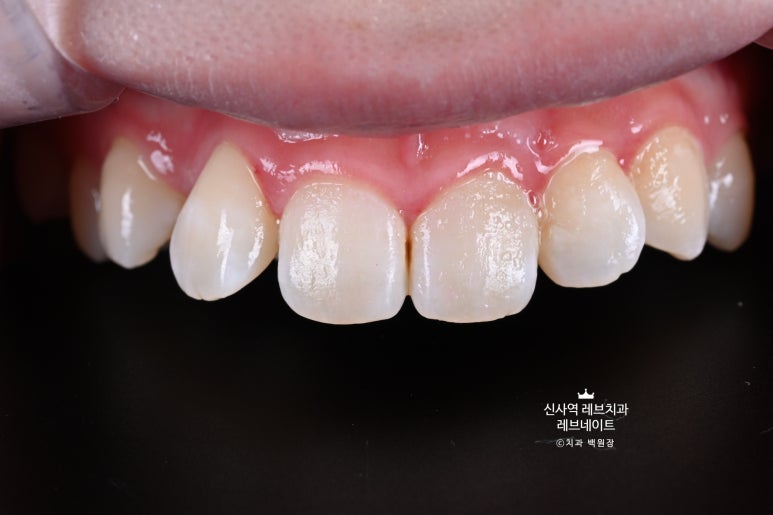 신사역 치과. 아나운서 면접 전 앞니 벌어진 공간을 라미네이트로만 해결할 수 있었던 사연.. 관련 이미지 6