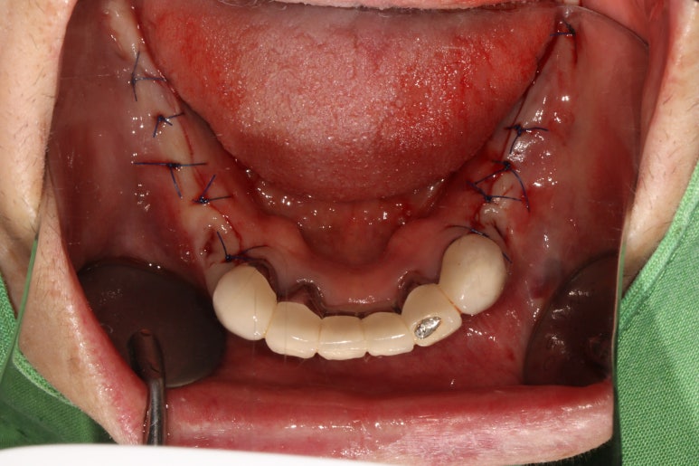 부분틀니를 오래써서 어금니가 아플 때, 아래턱 양쪽 어금니 임플란트 잘하는 강남임플란트치과 관련 이미지 12