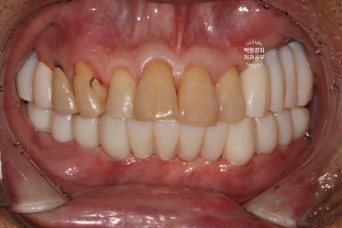 아래 어금니 임플란트 6개면 틀니를 안써도 됩니다.  치주염 전문 착한치과. 치료기간/임시치아과정/후기/비용. 관련 이미지 17