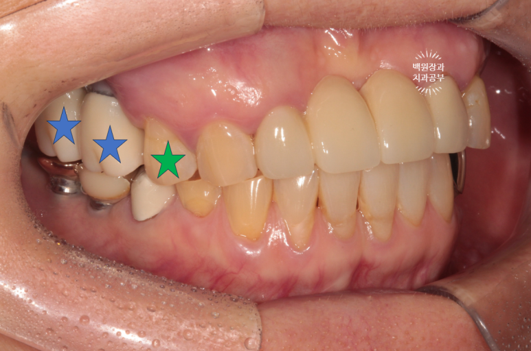 60대 임플란트 주변에서 고름이 나와요. 실패한 임플란트 제거 후 재수술. 덴티움 뼈이식재를 사용한 치조골 이식술. 관련 이미지 3