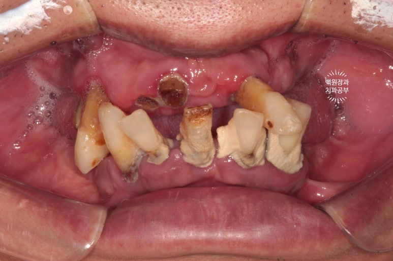만성치주염으로 인해 아주 좁아진 잇몸뼈에 광범위한 뼈이식 + 전체임플란트. 신사 레브치과. 관련 이미지 4