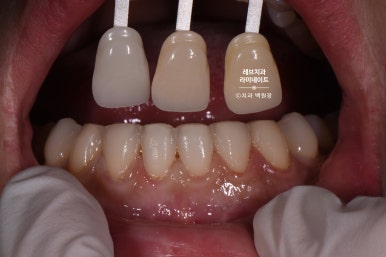 레브네이트 베이직. 치아미백과 치아교정을 한번에! 치아삭제 사진 있음. 신사역 치과 앞니라미네이트 모델/비용/후기. 관련 이미지 23