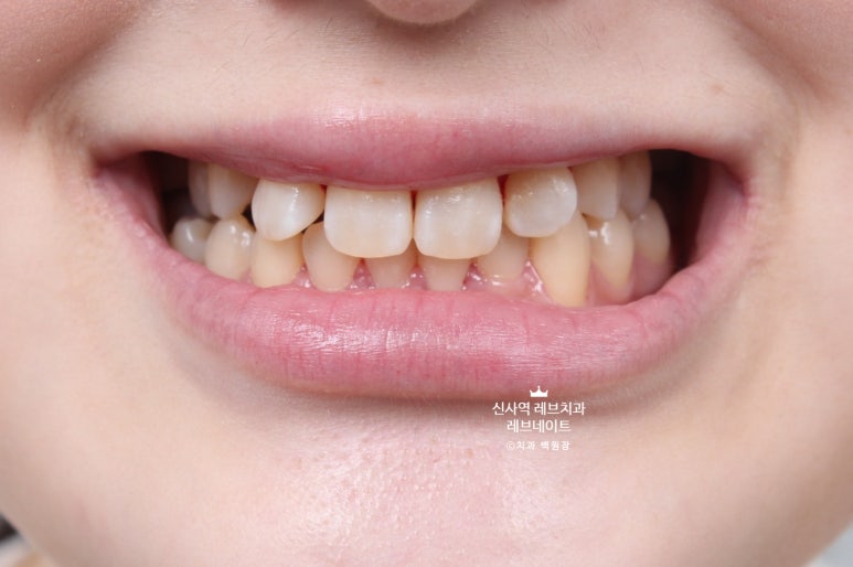 신사역 치과. 아나운서 면접 전 앞니 벌어진 공간을 라미네이트로만 해결할 수 있었던 사연.. 관련 이미지 7