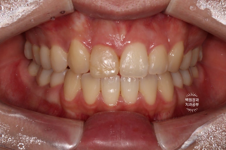 잇몸 성형과 치아미백 그리고 지르코니아 20대 앞니 크라운 치료. 치료과정/기간/비용. 관련 이미지 2