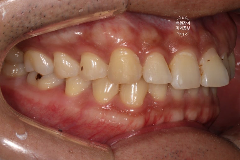 교정 유지장치 근처 앞니 옆면 충치 및 착색 간단히 3M 레진으로 치료. 치료과정/비용/후기. 과잉진료 없는 치과. 관련 이미지 4