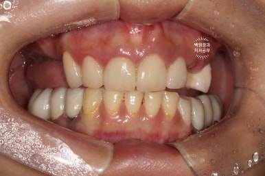 부분틀니 대신 어금니 임플란트를 만들어드립니다. 40대 어금니 상악동 뼈이식 임플란트. 치료기간/비용/과정. 관련 이미지 4