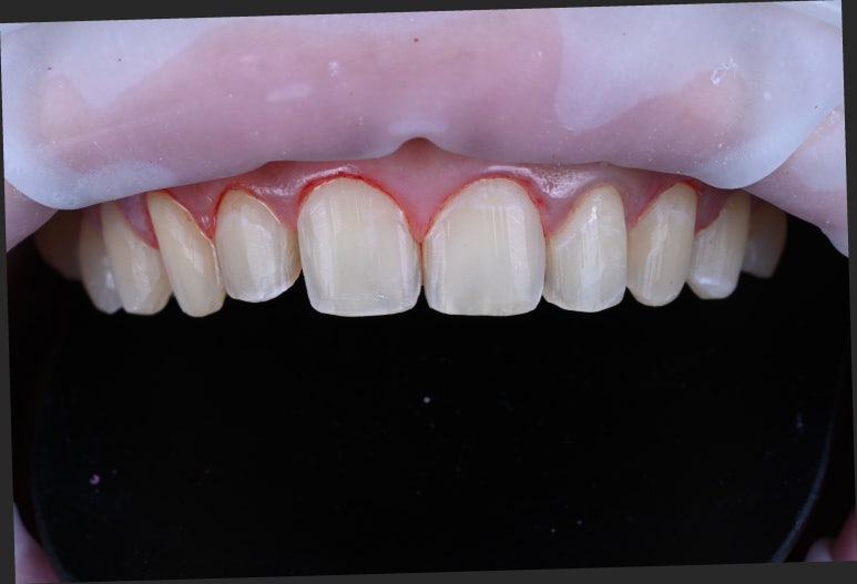 신사역 라미네이트. 결혼식 전 앞니 고민, 얇은 세라믹 레브네이트로 해결! 관련 이미지 13